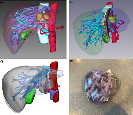 (A) 3D reconstruction of patient’s liver, tumor (yellow), arteries (red), portal vein branches (light blue), hepatic veins (blue); (B) potential transection plane; (C) digital segmentation for 3D printin; and (D) 3D printed model.