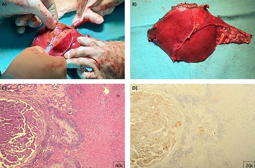 Pathology images (A) and (B) gross macroscopic pictures of excised specimen, an H&E stained slide (C) shows classic histologic features of papillary thyroid carcinoma confirmed by immunohistochemistry for thyroglobulin (D).