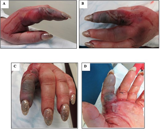 Images showing 65-year-old woman with initial features of NF to left hand; (A) radial view, (B and C) dorsal view, (D) volar view.