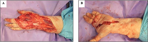 Image showing intraoperative findings post wound excision and amputation of LIF; (A) dorsal view (B) volar view.