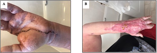 Images showing successfully salvage limb 6 weeks postoperatively; (A) volar view, (B) dorsal view.