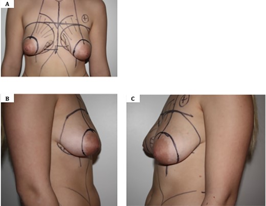 Pre-operative images showing tuberous breast deformity. A. Anterior view; B. Lateral view—right breast; C. Lateral view—left breast. Note asymmetry, widened NAC and herniation of breast parenchyma.
