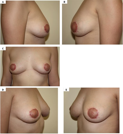 Six weeks post-operative images following correction of tuberous breast deformity using a Benelli approach to reduce NAC size followed by fat grafting. A. Lateral view—Right breast; B. Lateral view—left breast; C. Anterior view; D. Oblique view; E. Oblique view.