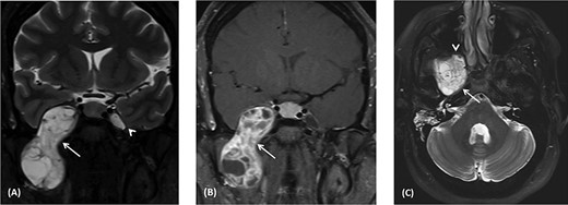 (A) Coronal T2 MRI shows dumbbell-shaped soft tissue mass with heterogenous high signal intensity across the widened oval foramen extending from the infratemporal fossa into Meckel’s cave (arrow). It displaces the temporal lobe superiorly and laterally. The left Meckel’s cave (arrowhead) is normal. (B) Coronal post-contrast T1 MRI shows heterogeneous enhancement of the right dumbbell mass across the right oval foramen (arrowhead). It shows multiple necrotic foci. (C) Axial T2 MRI shows heterogeneous high signal intensity mass at the level of foramen ovale abutting the petrous segment of the right internal carotid artery with no invasion (arrow). Anteriorly, the mass indents the posterior wall of the right maxillary antrum (arrowhead). Right mastoid air cells opacification secondary to obstructed right Eustachian tube.