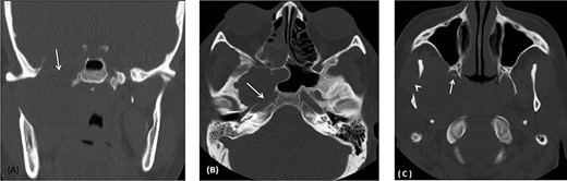 (A) Coronal CT image using bone window shows remodeling and widening of the oval foramen (arrow) secondary to infratemporal/middle cranial fossa mass. (B) axial CT images using bone window at the level of oval window demonstrates the widening of the canal with extension medially resulting in dehiscence of the anterior wall of the carotid canal (arrow). (C) Axial CT image using bone window at the infratemporal fossa level shows erosion and remodeling of the right pterygoid plates (Arrow) as well as the right mandible (arrowhead).