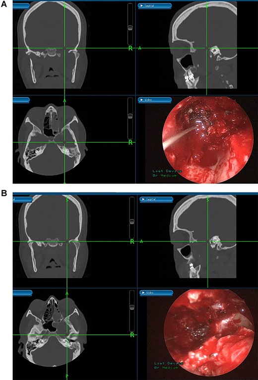 (A) Image-guided tumor removal from petrous carotid artery. (B) Image-guided intraoperative picture status post-complete tumor removal from trigeminal and middle cranial fossa.