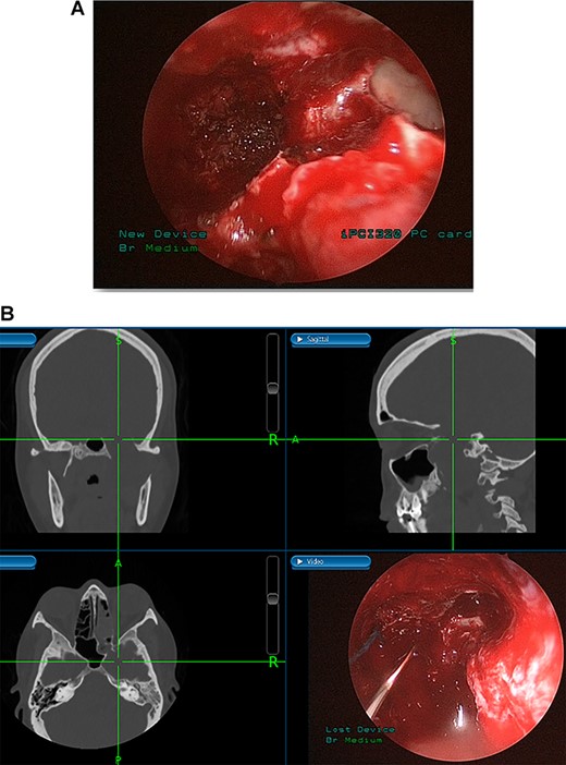 (A) Endoscopic view of the final surgical cavity after tumor removal. (B) Image-guided tumor removal from cavernous carotid artery.