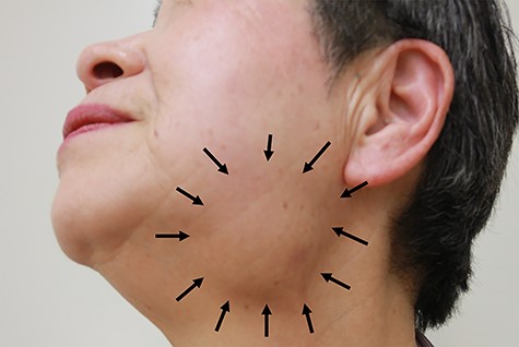 Photograph of the left submandibular mass.