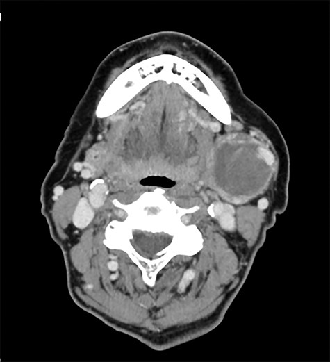 Preoperative axial enhanced computed tomography image.