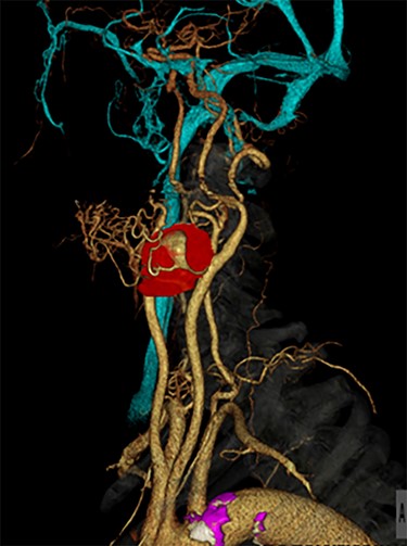 Preoperative contrast-enhanced computed tomography with 3D reconstruction.