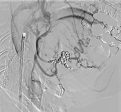 Postoperative trapping with coil.