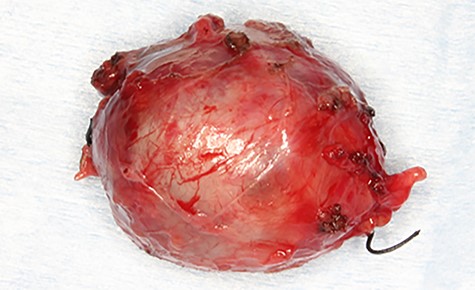 Photograph of the removed aneurysm. The coil was found in the extract.