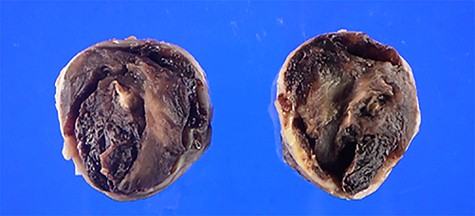Cross-section of the removed aneurysm. An arrow indicates the coil.