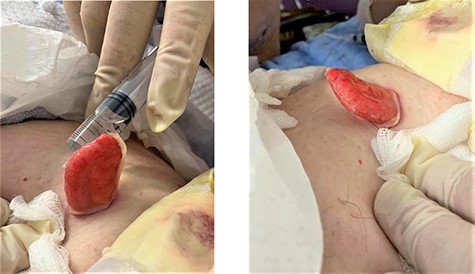 Herniation of appendix and mesoappendix through trocar site