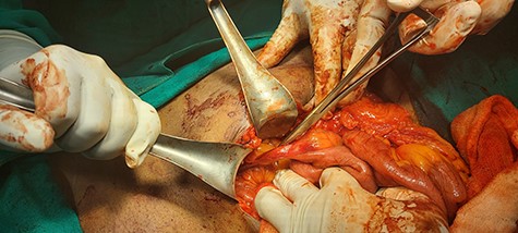 Proximal end of shunt traversing through ileum