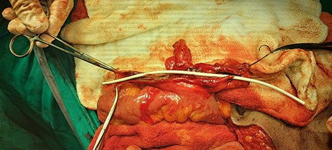 Fistula tract opened