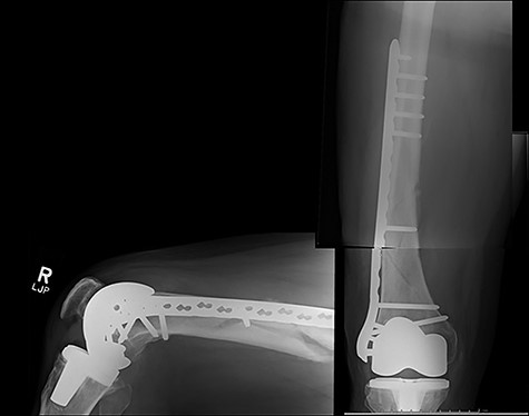 Post-operative radiographs for Case 1.