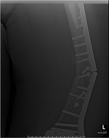 Plate fatigue fracture prior to successful union for Case 4.