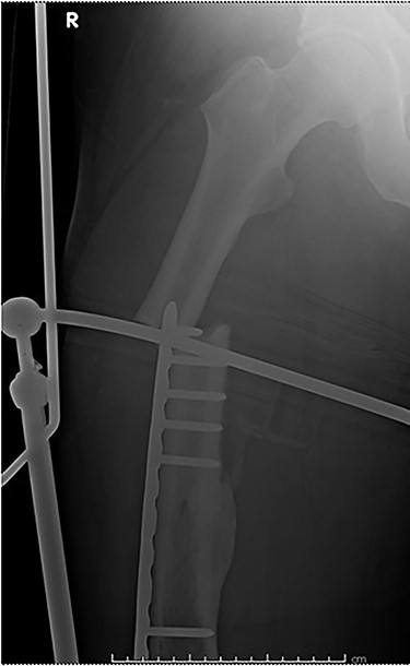 Fracture above plate tip following successful union for Case 1.