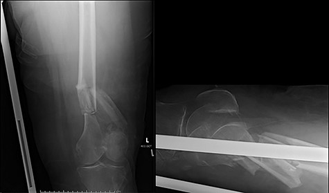 Radiographs at presentation for Case 2.