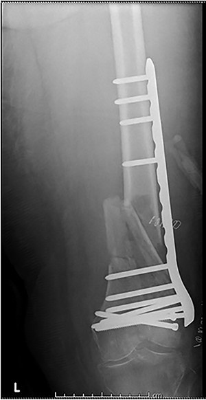 Post-operative radiograph for Case 2.