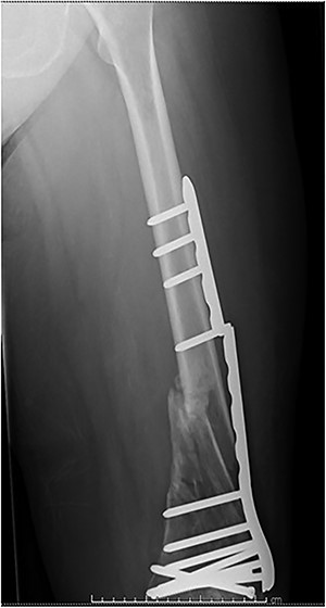 Plate fatigue fracture prior to successful union for Case 2.