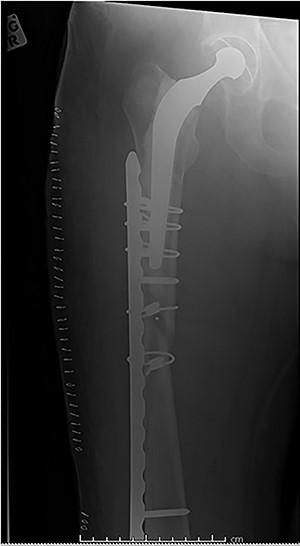 Post-operative radiograph for Case 3.
