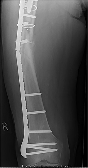 Plate fatigue fracture prior to successful union for Case 3.