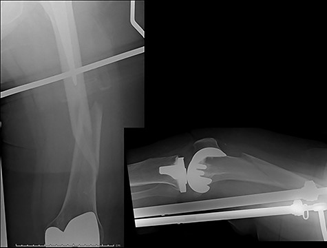 Radiographs at presentation for Case 4.