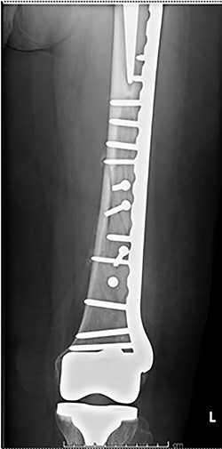 Post-operative radiograph for Case 4.