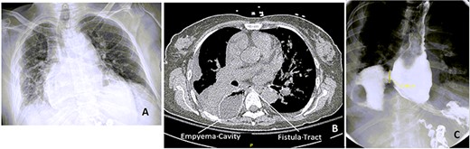 Chest x-ray (CXR), CT chest and esophagogram on the day of admission. (A) CXR showing right-sided pleural effusion and consolidation, (B) CT chest showing the empyema cavity and the fistula tract, (C) esophagogram showing a 2.5-cm mid-distal esophageal defect with contrast extravasting into the right pleural space.