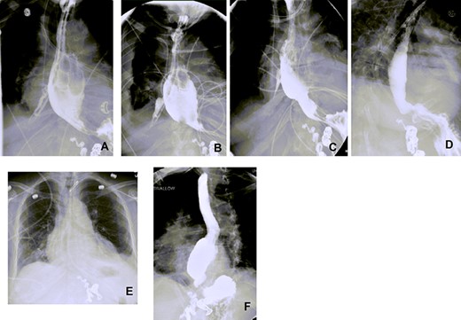 Esophagograms at various stages postadmission showing improvement in the size of the esophageal defect. (A and B) d13 and d19 Postadmission, respectively. NP tube in place ending into the right pleural space cavity. (C) d26 Postadmission with NP tube now retracted 5 cm, with decrease in the contrast extravasation seen. (D) d33 Postadmission with NP tube now removed showing no contrast extravasation seen with defect now healed. (E) CXR d41 postadmission showing improved right-sided pleural effusion and consolidation with no NP tube in place. (F) Outpatient follow-up esophagogram (d64 postadmission), (NP—nasopleural).