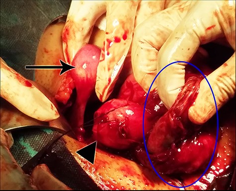 A view from the operation field demonstrating the right rudimentary uterine horn (arrow), the left unicornuate uterus (arrow’s head) and the fibrous wall of the endometrioma (blue circle).