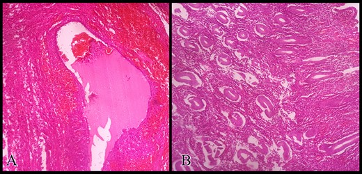 Histopathologic examination of the resected specimens stained with hematoxylin and eosin showing (A) the ovarian endometrioma and (B) the resected unicornuate uterus with its normal endometrium at the proliferative phase.