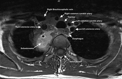 MRI showing paravertebral neurinoma with liquid content (C7-D3) with right intrathoracic involvement compressing the mediastinal structures without signs of vascular infiltration.