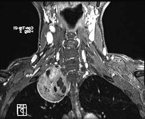 MRI of paracervical neurinoma in the coronal projection affecting the right paravertebral structures.
