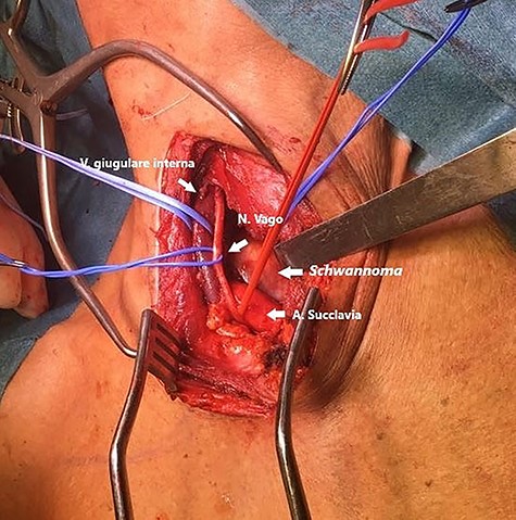 Right cervicotomic surgical approach showing the internal jugular vein, subclavian artery and vagus nerve. The lesion in its cervical portion is also visible.