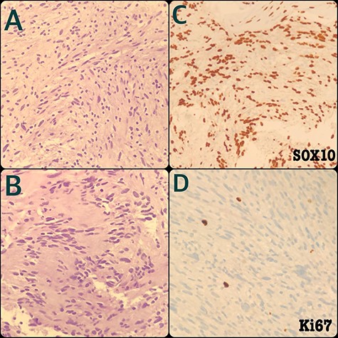 Schwannoma tumor cells are mostly spindled and arranged in short fascicles or vague whorls with indistinct cell edges (A) and sometimes for parallel nuclei rows around a central zone rich in eosinophilic fibrillary processes (Verocay bodies) (B). The cells are diffusely immunoreactive for S100 as well as SOX10 (C) and have low proliferative index (Ki67 <1%) without necrosis or mitotic figures (D).