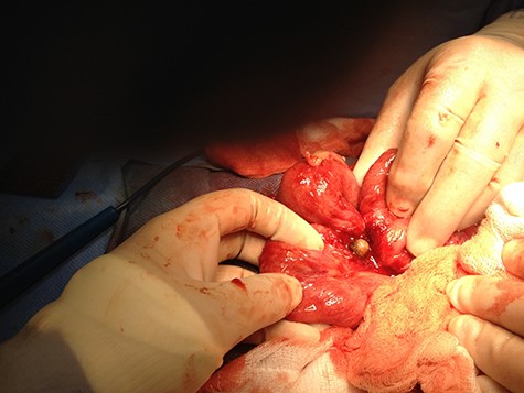 Intraoperative picture showing retained appendicolith with adhered small bowel.