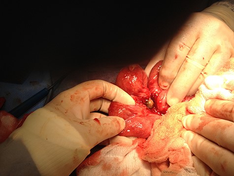 Intraoperative picture 2.