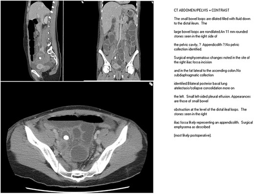 CT scan frame showing retained appendicolith.