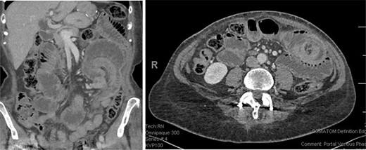 On the left coronal reconstruction showing the area of intussusception (top right); on the right an axial reconstruction showing the classical target sign suggesting intussusception (top right).