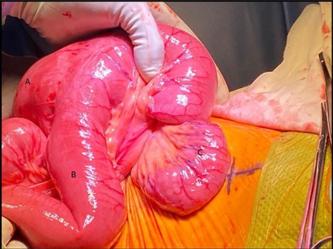 Intra-operative photo showing (A) alimentary limb, (B) pancreaticobilliary limb and (C) common limb with retrograde intussusception extending proximally into the anastomosis.