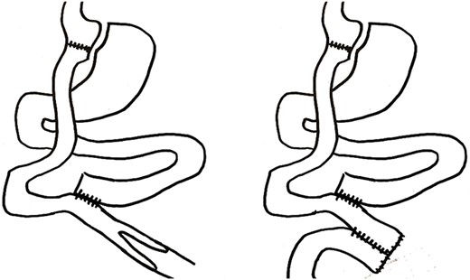 Diagram showing anatomy before and after surgery.