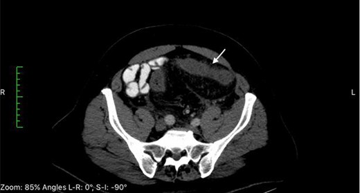 CT of the abdomen at time of admission reveals thickening of the sigmoid colon (white arrows).