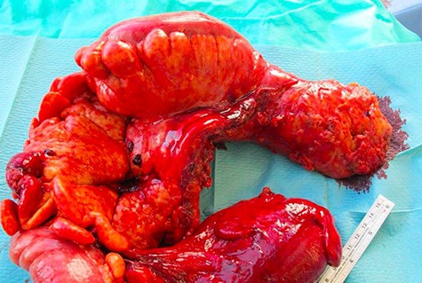Examination of the 75 cm specimen revealed macroscopic features of ischemia with indurated brown-reddish bowel wall and bulky hardened mesenteric fat tissue.