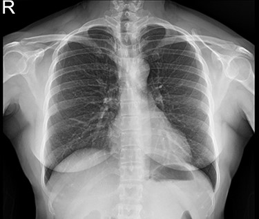 Chest X-ray (PA view)—no mediastinal widening, normal study. PA, posteroanterior.