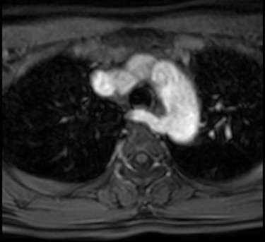 MRI with contrast showing right aberrant subclavian artery taking turn behind the trachea and esophagus.