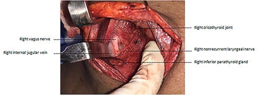 Intraoperative photograph after ligation of branches of the inferior thyroid artery.
