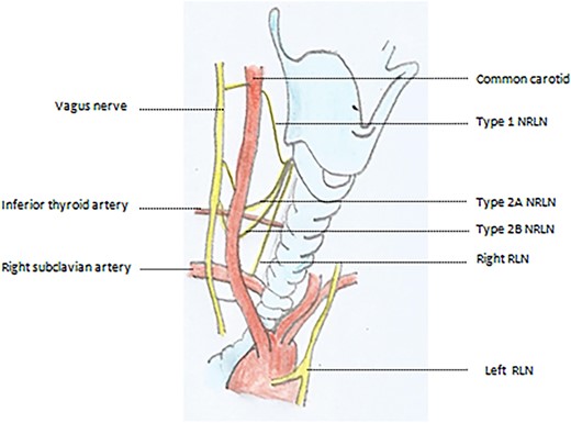 Types of NRLN with respect to inferior thyroid artery.